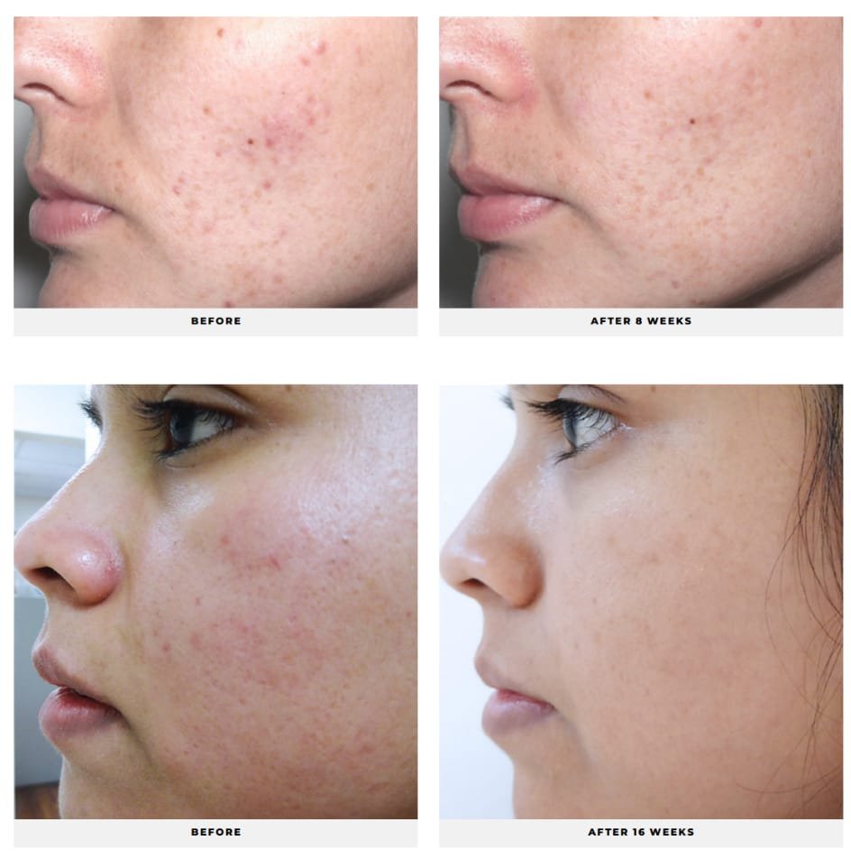 Acne Control System - Image 6